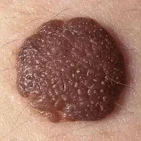 درمان قطعی ضایعات پوستی/HPV