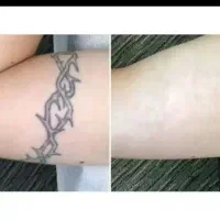 لیزر کیوسوئیچ حذف تتو و ریممو ابرو و سفید کنندگی