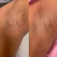 افتتاحیه لیزرموتخفیف ویژه به مدت سه روز ۵۰درصد