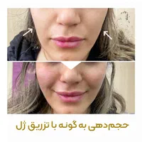 ژل وبوتاکس|خدمات آرایشگری و زیبایی|قم, شهرک فاطمیه|دیوار