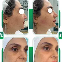 هایفو تراپی/پلاژن تراپی/کربوکسی/لیزربدن|خدمات آرایشگری و زیبایی|مشهد, محمدآباد|دیوار