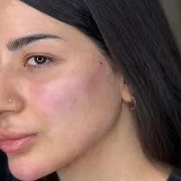 انجام کلیه خدمات فیلر و بوتاکس در کلینیک