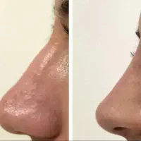 تزریق ژل فیلر بوتاکس مزو فیلر بادی قیمت استثنایی|خدمات زیبایی و سلامت|شیراز, فضل‌آباد|دیوار