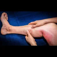 درمان موثر دردهای زانوساق پاوسوزش کف پا پزشک متخصص