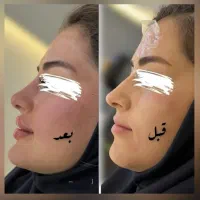 لیزرمو ژل لب فول فیس فیلر چانه گونه مزوبوتاکسprp