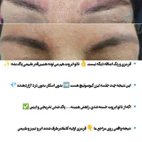 پاک کردن تتو صورت و بدن با دستگاه لیزر کیوسوییچ|خدمات آرایشگری و زیبایی|فلاورجان, |دیوار