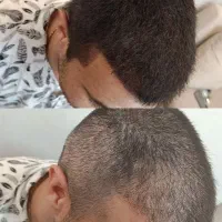 آموزش و خدمات میکرواسکالپ مکمل کاشت مو