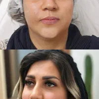 تخفیفات بلک فرایدی تزریق فیلر و بوتاکس رایگان|خدمات آرایشگری و زیبایی|ساری, |دیوار