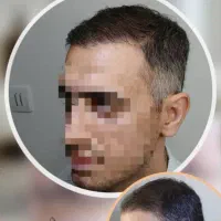 کاشت مو و کاشت اَبرو|خدمات آرایشگری و زیبایی|فسا, |دیوار