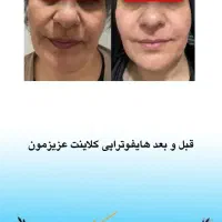 پاکسازی جوانسازی پوست و خالبرداری و مزو و بوتاکس|خدمات آرایشگری و زیبایی|سمنان, |دیوار