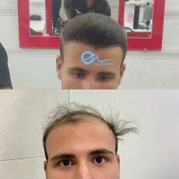 کاشت مو نقد و اقساط