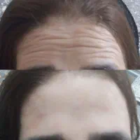 ژل و بوتاکس