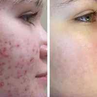 پاکسازی پوست صورت تخصصی (فیشیال vip)|خدمات آرایشگری و زیبایی|سنندج, |دیوار