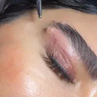 جشنواره عمل بلفاروپلاستی و ساکشن غبغب