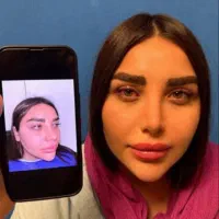 جراحی بلفاروپلاستی|خدمات آرایشگری و زیبایی|تهران, هفت حوض|دیوار