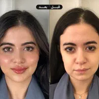 جشنواره ژل لب گونه چونه زاویه فک فیلرزیرچشم بوتاکس|خدمات آرایشگری و زیبایی|تهران, قلهک|دیوار