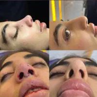 آف ویژه زیبایی بینی|خدمات آرایشگری و زیبایی|بهبهان, |دیوار