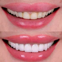 جشنواره اقساطی کامپوزیت و لمینت دندان (چک و سفته)