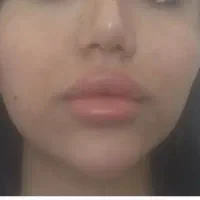 تزریق ژل وبوتاکس ژل لب گونه چانه زاویه خط لبخند|خدمات آرایشگری و زیبایی|کرمانشاه, |دیوار