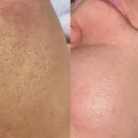 تخفیف یلدایی پاکسازی پوست فقط ۵۰۰تومن|خدمات آرایشگری و زیبایی|محمدیه-قزوین, |دیوار