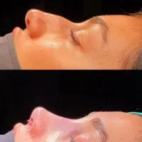 جشنواره جراحی و عمل بینی/پیکرتراشی/لیفت|خدمات زیبایی و سلامت|کرج, عظیمیه|دیوار
