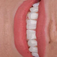 ایمپلنت دندان دیجیتال و فوری با اقساط بلند مدت