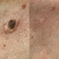 نابود کننده زگیل و منگوله گوشتی