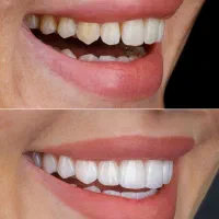 کامپوزیت.روکش دندان.مصنوعی.اقساط بدون سود