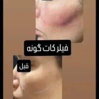 ژل لب گونه چونه زاویه مادلینگ راویه سازی|خدمات آرایشگری و زیبایی|قم, تولید دارو و یخچال|دیوار