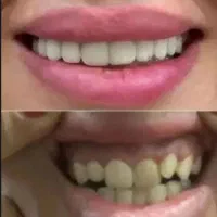 اقساط ویژه ایمپلنت دیجیتال،اوردنچر،دندان مصنوعی..|خدمات زیبایی و سلامت|تهران, مجیدیه|دیوار