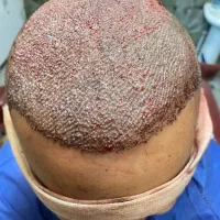 کاشت موی طبیعی