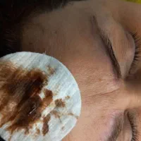 پاک کردن تتوهای قدیمی