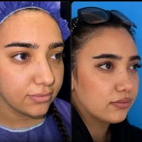 جراحی بینی (با تخفیف ویژه فقط ۴۰تا پایان آبان ماه)