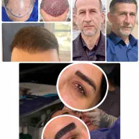 کاشت مو و ابرو طبیعی