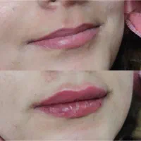 ژل،فیلر لب فقط 590|خدمات آرایشگری و زیبایی|کرج, چهارصد دستگاه|دیوار