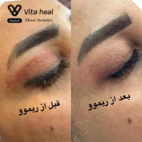 جشنواره یلدایی ریموو تخصصی تتو ابرو چشم و لب|خدمات آرایشگری و زیبایی|شیراز, تندگویان|دیوار