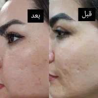 جوش لک و چین چروک امانت بریده|آرایشی، بهداشتی، درمانی|اهواز, آریاشهر|دیوار