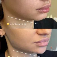 تزریق ژل لب بوتاکس مزو نخ آنزیم لیفت پکیج۱۰ سی سی|خدمات آرایشگری و زیبایی|تهران, مرزداران|دیوار