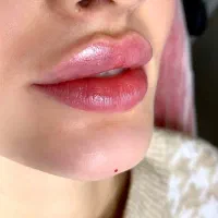 مدل برای ژل و بوتاکس فقط امروز