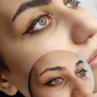 مدل میکروبلیدینگ، فیبروز