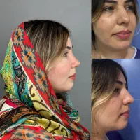 جراحی بینی با روش پیزوسرجری ،جشنواره فروردین