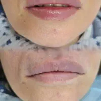 لیزر|خدمات آرایشگری و زیبایی|خرمآباد, |دیوار