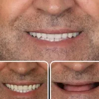 پروتز دندان مصنوعی