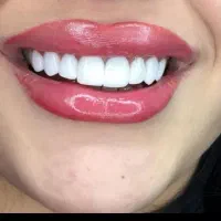 دندانپزشک اقساط کامپوزیت لمینیت لب شیشه ای بلیچینگ|خدمات آرایشگری و زیبایی|مشهد, سجاد شهر|دیوار