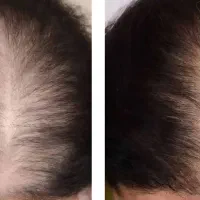 پی آر پی و مزوتراپی مو و ابرو|خدمات آرایشگری و زیبایی|اردبیل, |دیوار