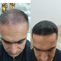 کاشت موی تخصصی با ضمانت نامه کتبی