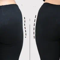 ساکشن چربی ترانسفر به هیپ دیپ و باسن فیلربادی غبغب