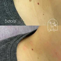 برداشت انواع خال صورت و بدن|خدمات آرایشگری و زیبایی|اهواز, کیانپارس |دیوار
