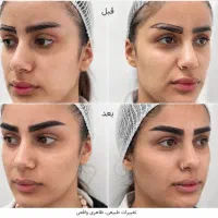کاشت ابرو، تکمیل ظرفیت شهریور فقط ۱۰ تومان|خدمات زیبایی و سلامت|تهران, شاهین|دیوار