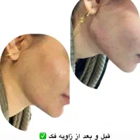 تزریق فیلر و بوتاکس و نخ توسط دستیار پزشک|خدمات آرایشگری و زیبایی|خرمشهر, |دیوار